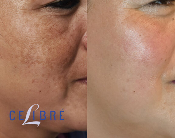 Hydroquinone freckle treatment: before & after photos showing reduced freckles.