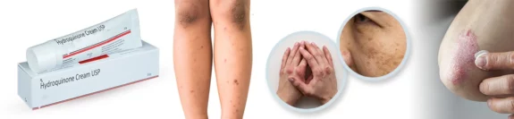 Dark Spot Hydroquinone cream for skin lightening.