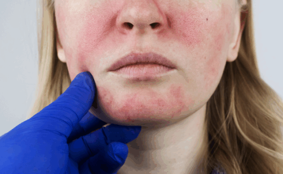 Hyderquin Plus Cream side effects information.