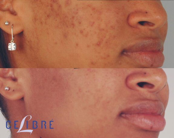 Hydroquinone cream for burn scar treatment.