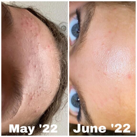 Tretinoin & CeraVe Moisturizing Cream