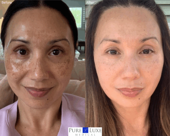 Zo Skin Health Pigment Control: Before & After.