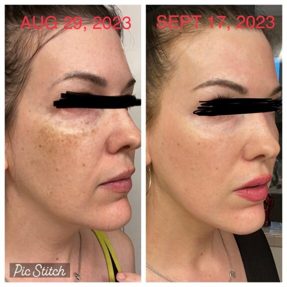 Hydroquinone 4% skin lightening cream