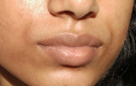 Hydroquinone lip treatment product.