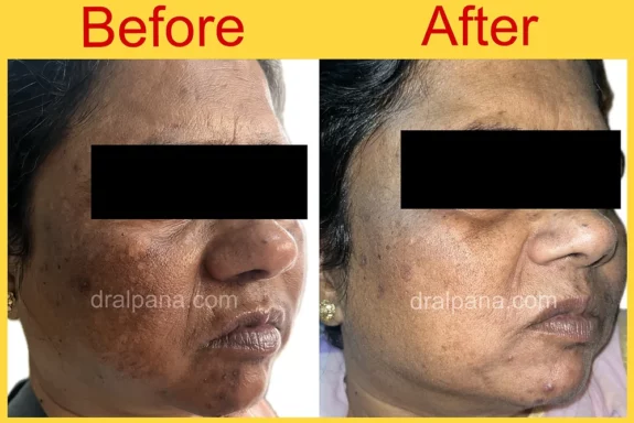 Hiquin Cream: Before & After results. See visible improvement.