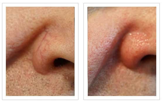 Tretinoin cream for treating broken capillaries.