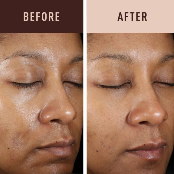 Hydroquinone cream before & after results: showing skin improvement.