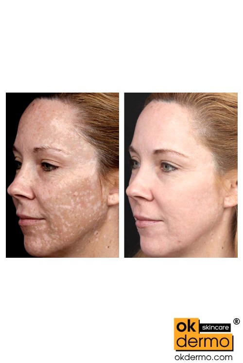 Hydroquinone face cream, all-over treatment.