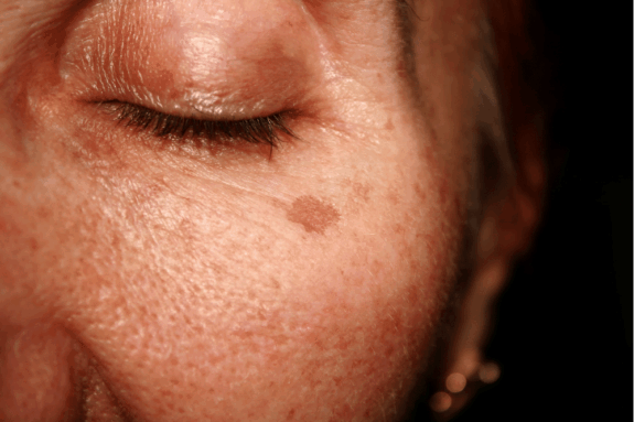Hydroquinone Cream NHS: Image of cream tube.