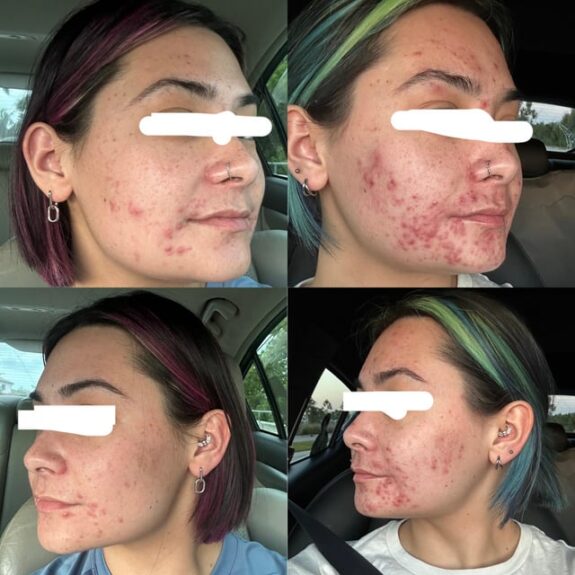Acretin acne treatment medication box