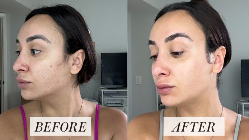Tretinoin gel before & after: showing improved skin texture and tone.