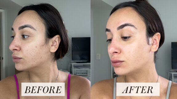 Tretinoin before & after skin improvement photos.