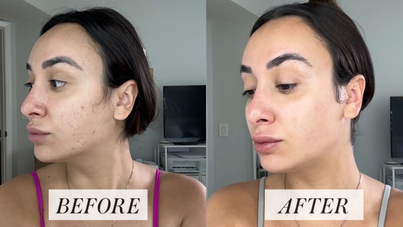 Retin-A before & after: showing improved skin texture and tone.