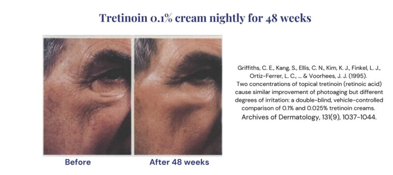 Before & after photos showing retinol tretinoin skincare results.