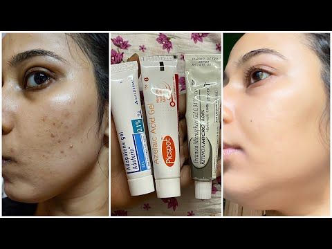 Tretinoin Dark Spot Cream, skincare product