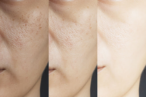 Hydroquinone face cream.