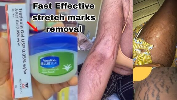 Tretinoin Cream 0.1% for stretch marks.