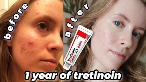Tretinoin 0.05% before & after skin improvement photos.
