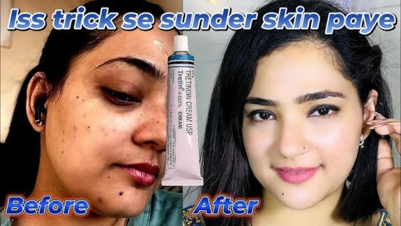 Tretinoin cream for skin lightening.