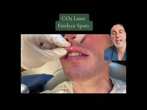 Fordyce Spots Tretinoin treatment cream.