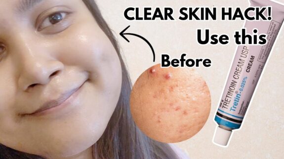 Retin-A 0.025% cream before & after results.