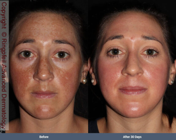 Refissa before & after: showing improved skin texture and tone.