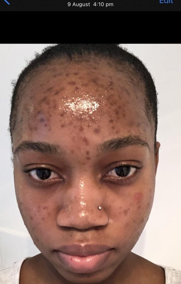 Tretinoin and hydroquinone cream.