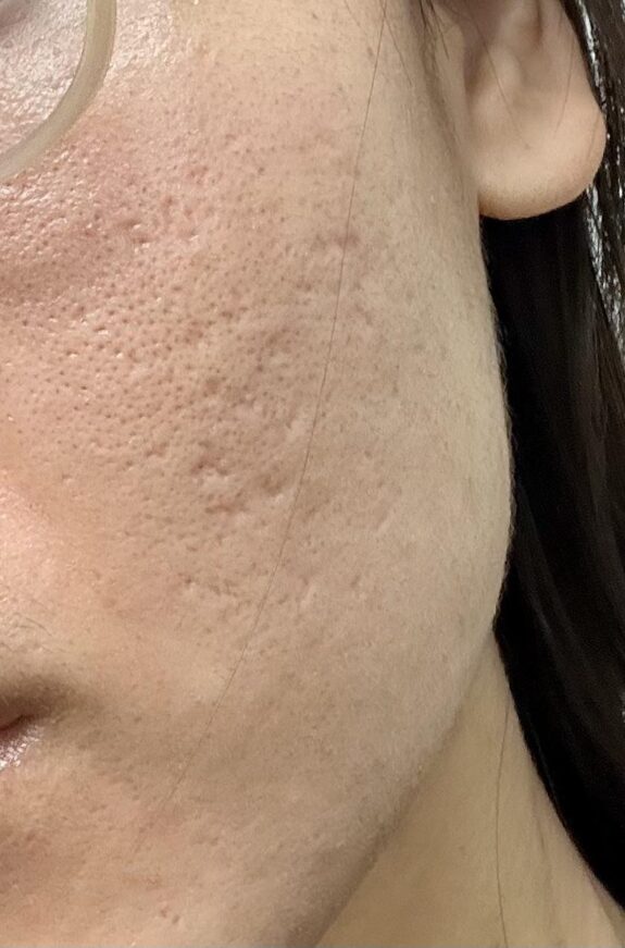 Tretinoin cream for treating ice pick scars.