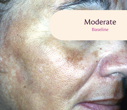 Triluma cream for melasma treatment.
