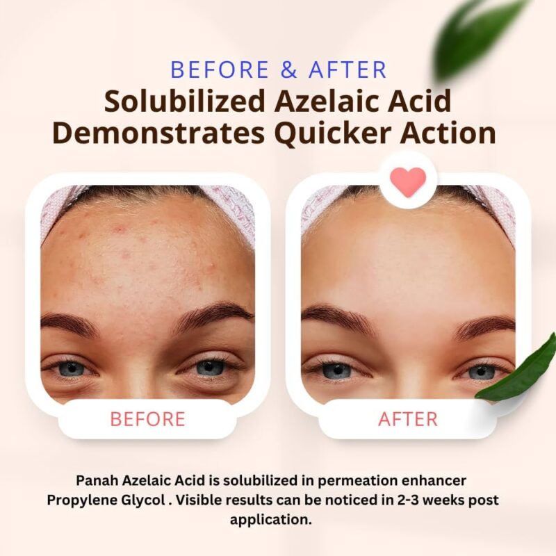 Azelaic acid gel before & after: improved skin clarity.