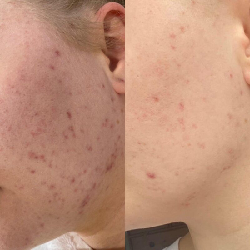 Finacea Gel before & after: Clearer skin results.