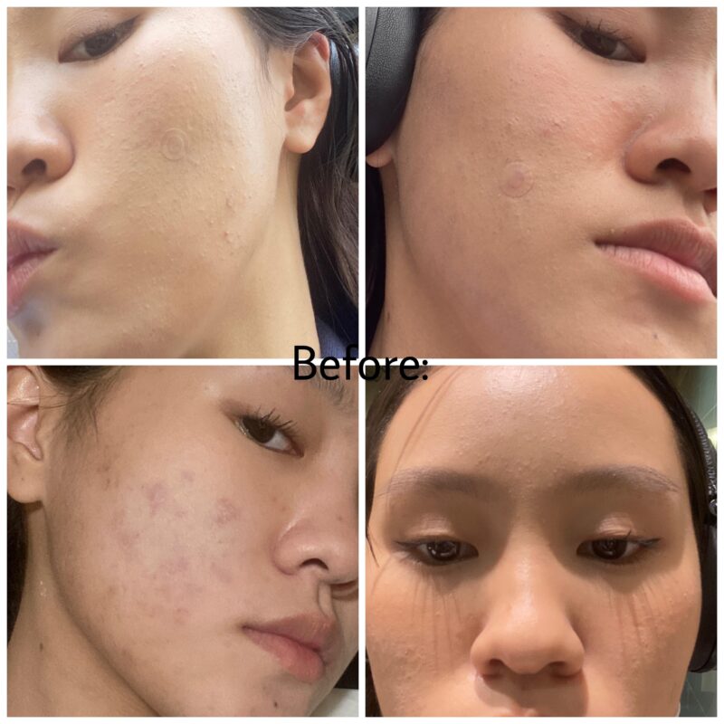 Skinoren Azelaic Acid: Before & After treatment results.