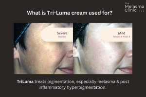 Tri Luma serum for hyperpigmentation treatment.