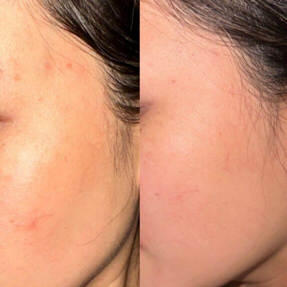 Finacea gel tube for acne treatment.